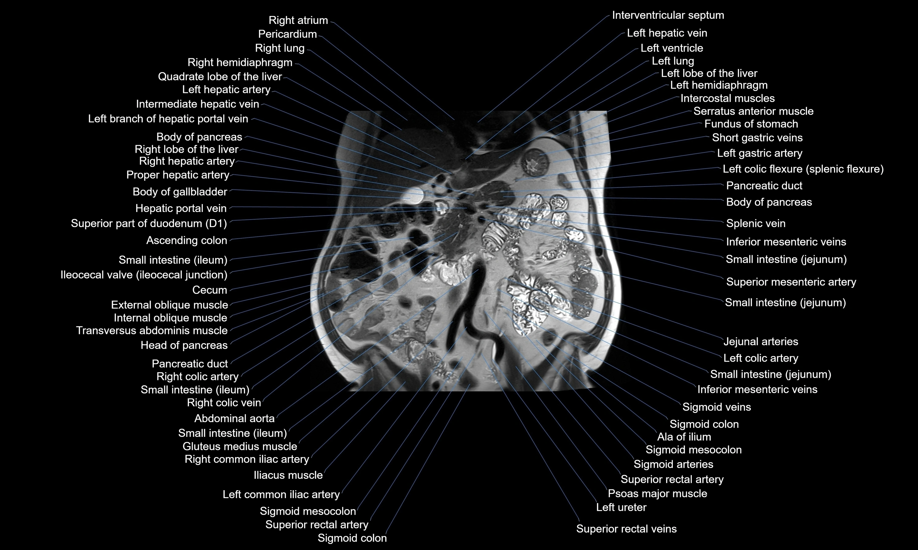 MRI Abdomen axial cross sectional anatomy radiology  image-img-00001-00027.webp